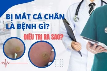 BỊ MẮT CÁ CHÂN LÀ BỆNH GÌ? ĐIỀU TRỊ RA SAO?